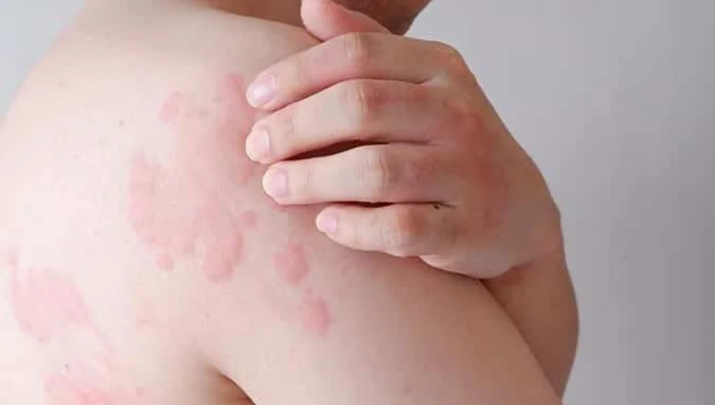 Contact Dermatitis