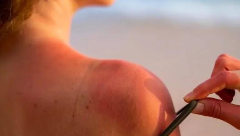 Got Sunburned_ Learn the Risks and How to Prevent It