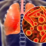 What Is Pneumonia_ A Complete Guide to Symptoms and Treatment