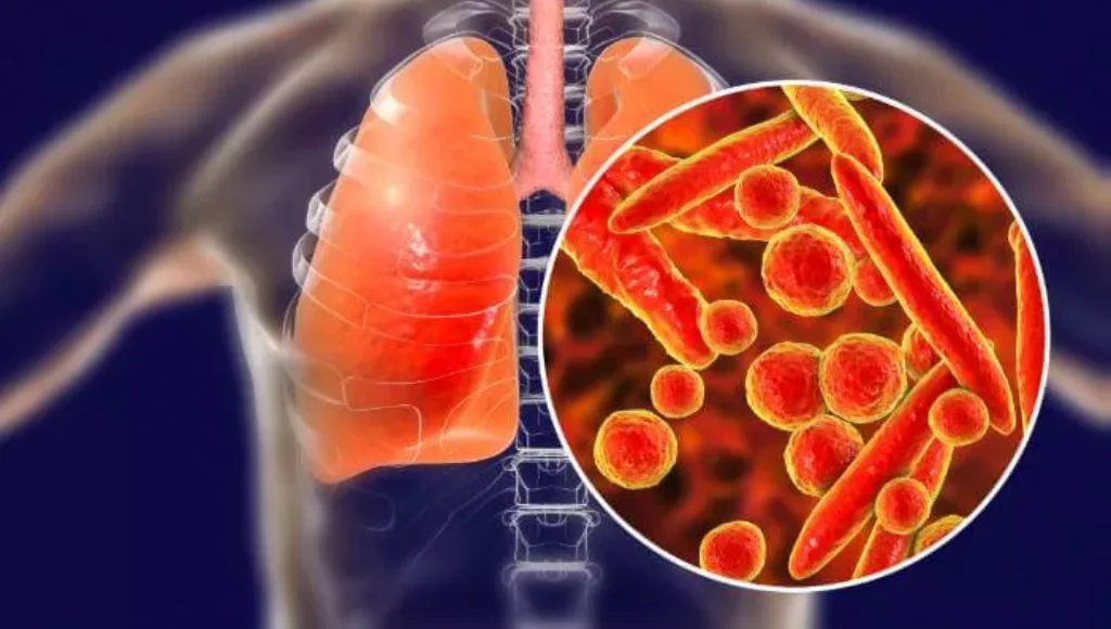 What Is Pneumonia_ A Complete Guide to Symptoms and Treatment