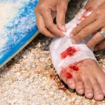 Surfing Injuries in Uluwatu and Pecatu_ From Treatment to Insurance Claims