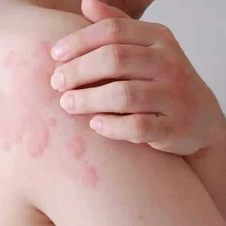 Contact Dermatitis