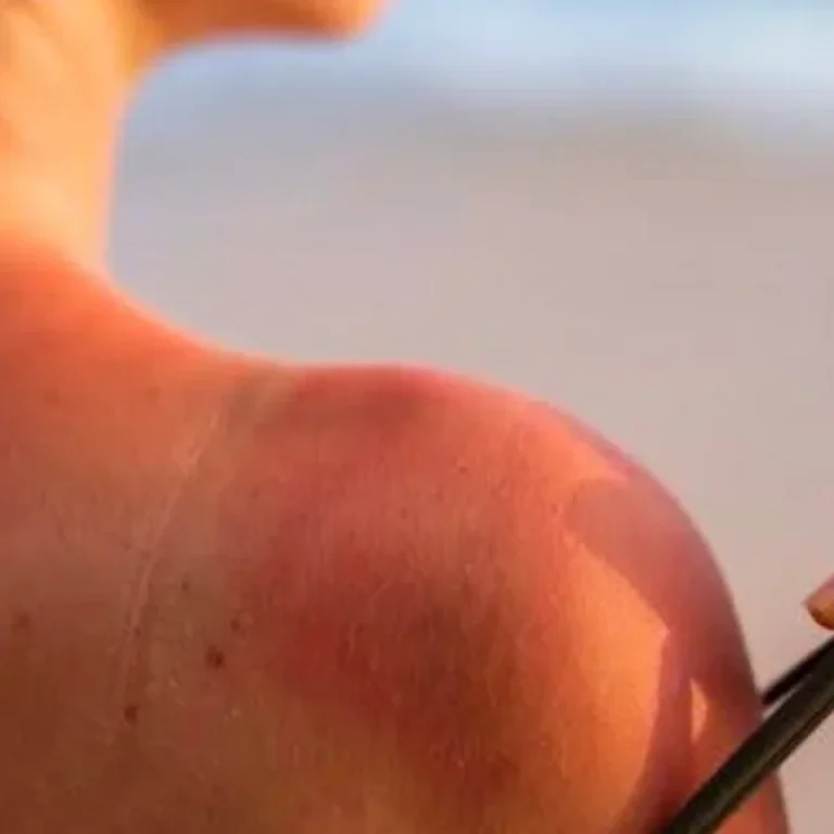 Got Sunburned_ Learn the Risks and How to Prevent It