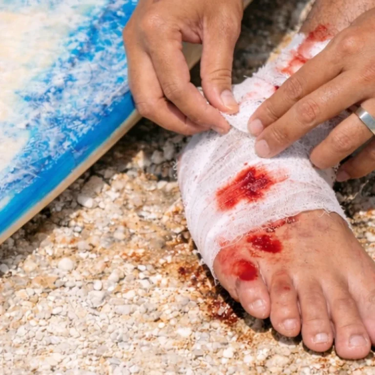 Surfing Injuries in Uluwatu and Pecatu_ From Treatment to Insurance Claims